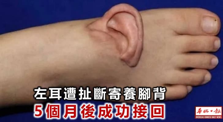 أطباء يزرعون أذن امرأة تعرضت للبتر.. في قدمها!